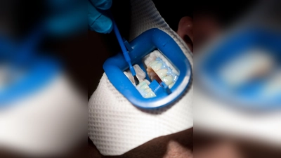 Auf die Zähne kommt beim Bleaching ein Bleichmittel - das blaue Gel schützt dabei das Zahnfleisch. (Foto: Klaus-Dietmar Gabbert/dpa-tmn)