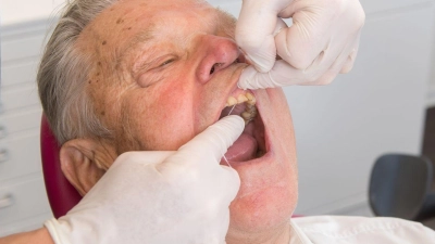 Regelmäßige professionelle Zahnreinigungen und tägliche Zahnseidenpflege sind entscheidend zur Vermeidung von Wurzelkaries, besonders im Alter (zu dpa: „Mit guter Mundhygiene Wurzelkaries vorbeugen“) (Foto: Benjamin Nolte/dpa-tmn/dpa)