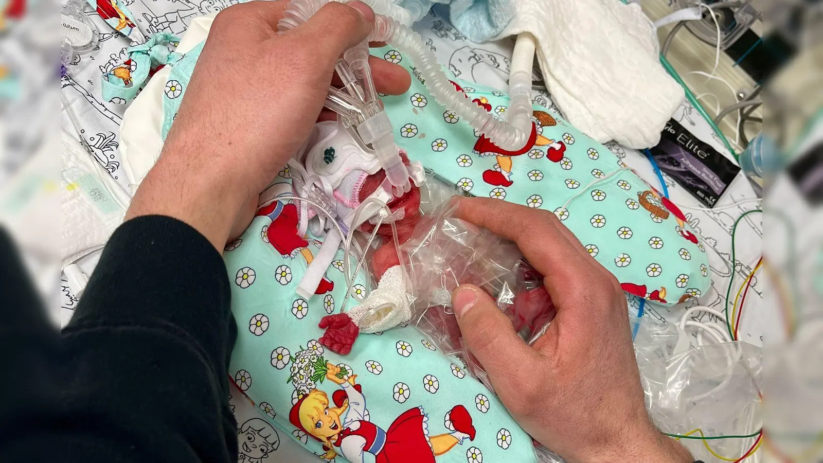 Etwas mehr als ein Päckchen Butter wog die kleine Marie, als sie im Februar zur Welt kam. Seitdem ist das Kind gut gewachsen. (Foto: Privat/Kinderklinik Dritter Orden Passau/dpa)