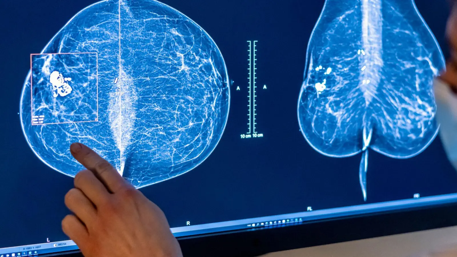 2023 wurden rund eine halbe Million Menschen in Deutschland mit Krebs diagnostiziert. (Symbolbild) (Foto: Hannibal Hanschke/dpa)