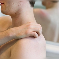 Dermatophilose, auch Regenfäule genannt, ist eine seltene, sexuell übertragbare Hautinfektion. (Foto: Friso Gentsch/dpa/dpa-tmn)
