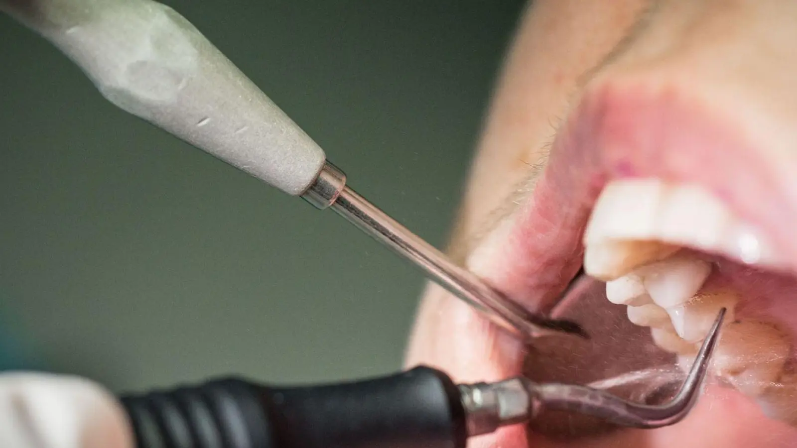 Besser man lässt ihn gar nicht erst entstehen, denn Zahnstein lässt sich nur mit einer professionellen Zahnreinigung entfernen. (Foto: Frank Rumpenhorst/dpa-tmn)
