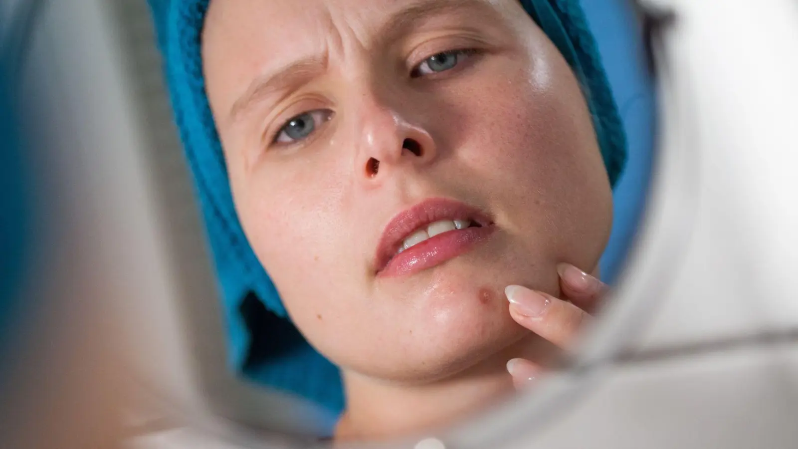 Mist, ein Pickel! Durch vermehrte Talgproduktion können Poren verstopfen und sich entzünden. Das stört viele nicht nur optisch, sondern tut manchmal auch richtig weh.  (Foto: Christin Klose/dpa-tmn)