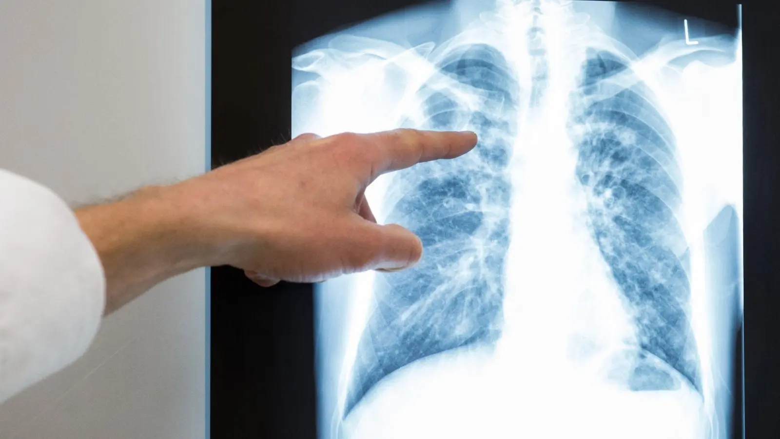Röntgenbild einer Lunge. Im vergangenem Jahr würden rund 4480 neue Tuberkulose-Fälle in Deutschland registriert. (Foto: Silas Stein/dpa)