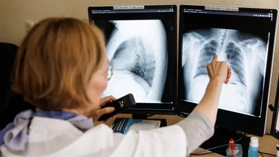 Eine Radiologin analysiert in ihrem Büro Röntgenbilder einer Lunge. (Foto: Matthias Balk/dpa)
