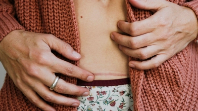 Sanfte Massagen und wenig Spannung: Das tut frischen Narben gut.  (Foto: Gemma Ferrando/Westend61/dpa-tmn)