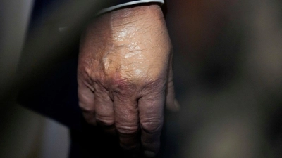 Nachdem der Bluterguss am Handrücken für Aufsehen sorgte, wurde er häufig bei Auftritten zugeschminkt. (Archivbild) (Foto: Julia Demaree Nikhinson/AP/dpa)