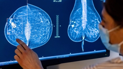 Die Möglichkeiten zur Mammographie für die Früherkennung von Brustkrebs soll ausgeweitet werden. (Foto: Hannibal Hanschke/dpa)