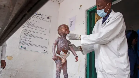 Ein Arzt in Mogadischu trägt Hautcreme auf ein Kind auf, das Symptome von Kwashiorkor zeigt, einer schweren Eiweißunterernährung, die Schwellungen und Hautläsionen verursacht. (Foto: Farah Abdi Warsameh/AP/dpa)