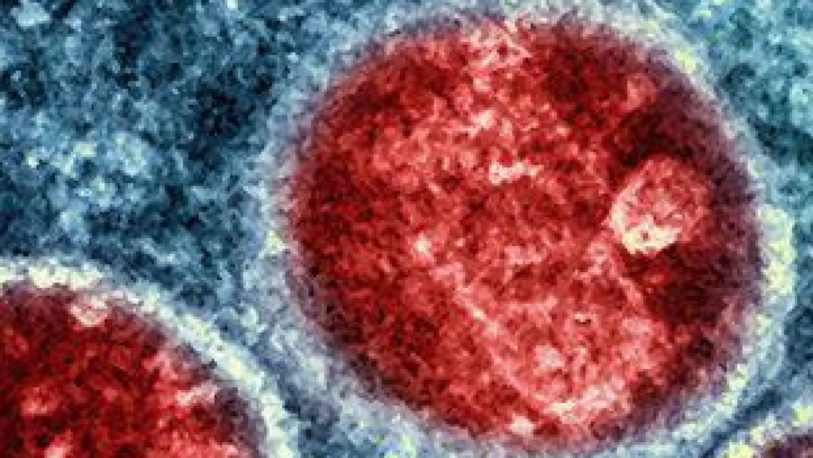 Die eitrigen Pusteln können am ganzen Körper auftreten und sehr schmerzhaft sein. (Symbolbild) (Foto: -/National Institute of Allergy and Infectious Diseases/dpa)