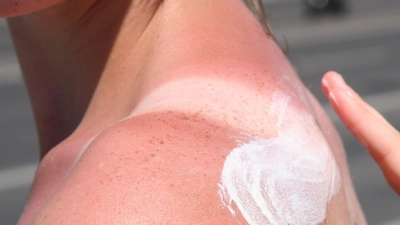 Bei Sonnenbrand ist Hautpflege gefragt: Feuchtigkeitsspendende Lotionen mit Aloe vera helfen der geschädigten Haut. (Foto: Stephanie Pilick/dpa/dpa-tmn)