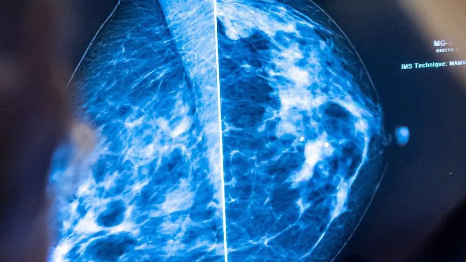 Bei Frauen ist Brustkrebs die verbreitetste Form von Krebs. (Foto: Hannibal Hanschke/dpa)