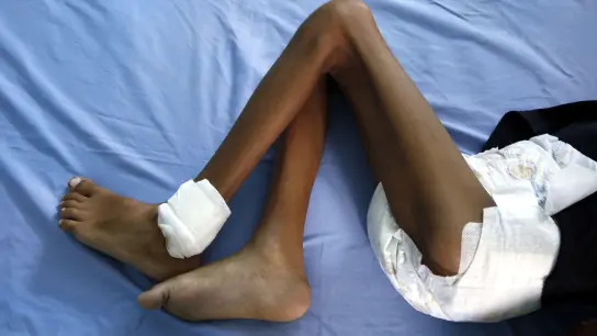 Ein unterernährtes Kind liegt in einem Krankenhaus im Jemen. Einer Studie zufolge könnte ein regionaler Atomkrieg weltweit Hungersnöte auslösen. (Foto: Mohammed Mohammed/XinHua/dpa)