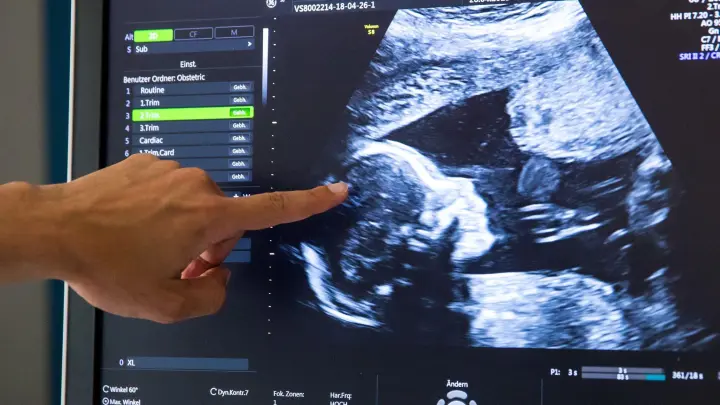 Während einer pränatalen Ultraschall-Untersuchung einer in der 18. Woche schwangeren Frau deutet ein Arzt auf den Kopf des Kindes. (Foto: Daniel Karmann/dpa)
