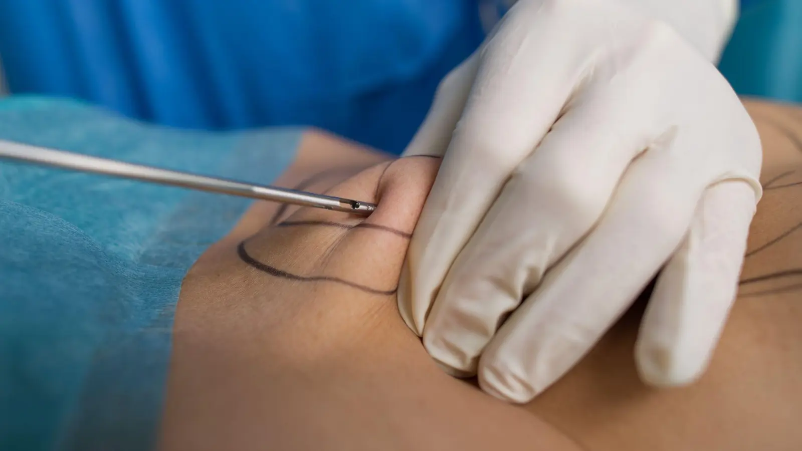 Unter bestimmten Voraussetzungen trägt die gesetzliche Krankenversicherung künftig die Kosten für eine Liposuktion. (Foto: Uwe Anspach/dpa-tmn)