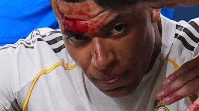 Mbappé wurde im Spiel gegen Girona im Gesicht getroffen. (Foto: Manu Fernandez/AP/dpa)