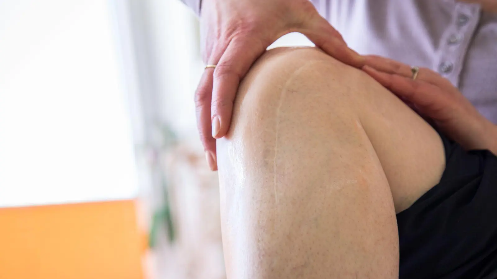 Es geht nicht nur ums Aussehen: Narben, die unschön verheilen, sind manchmal auch ein medizinisches Problem.  (Foto: Christin Klose/dpa-tmn)