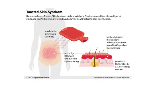 Gitterförmige Verfärbungen der Haut: Wer die an sich beobachtet, ist wahrscheinlich vom Toasted-Skin-Syndrom betroffen. (Foto: dpa-infografik GmbH/dpa-tmn)