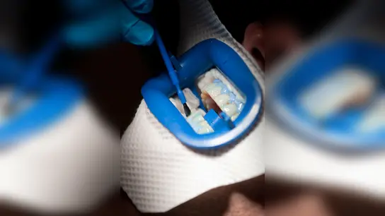 Auf die Zähne kommt beim Bleaching ein Bleichmittel - das blaue Gel schützt dabei das Zahnfleisch. (Foto: Klaus-Dietmar Gabbert/dpa-tmn)
