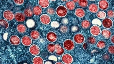 Eine eingefärbte Mikroskopaufnahme von Mpox-Partikeln (rot) in einer infizierten Zelle (blau), die im Labor kultiviert wurde. (Foto: National Institute of Allergy and Infectious Diseases/AP/dpa)