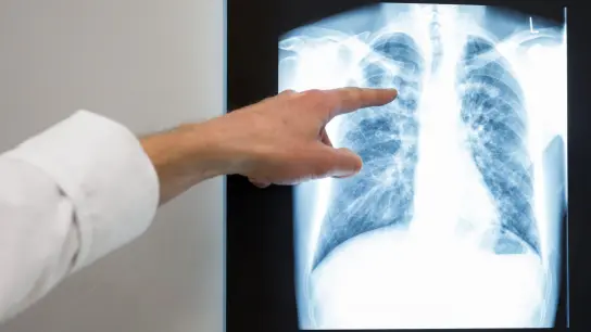 Ein Arzt zeigt im Vivantes Klinikum Neukölln auf das Röntgenbild einer Lunge. (Foto: Silas Stein/dpa/Archivbild)