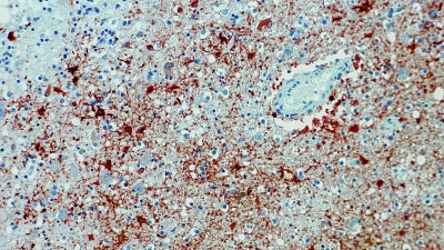 Die undatierte Aufnahme zeigt einen Anitkörpernachweis zum Borna-Virus im Gewebe. (Foto: Bernhard-Nocht-Institut für Tropenmedizin/dpa)