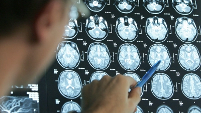 Wer einen Schlaganfall erleidet, ist im Durchschnitt rund 75 Jahre alt.  (Foto: Friso Gentsch/dpa/dpa-tmn)