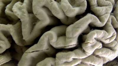 Eine Nahaufnahme eines menschlichen Gehirns, das von der Alzheimer-Krankheit betroffen ist, ausgestellt im Museum für Neuroanatomie an der University at Buffalo. (Foto: David Duprey/AP/dpa)
